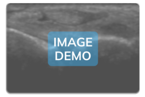 Tarsal sinus